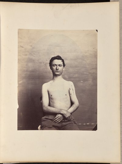 Herstel na excisie van de kop van de linker humerus voor schotwondfractuur door William H. Bell