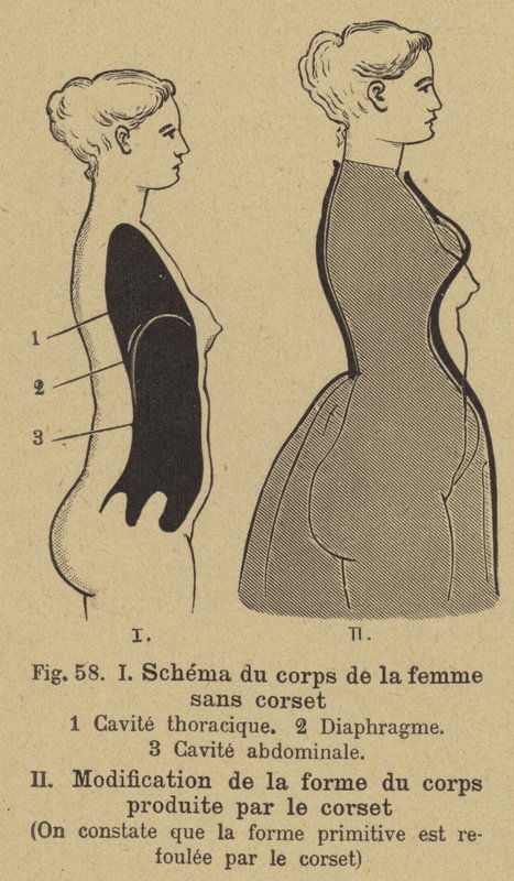 Diagram dat het effect van het dragen van een korset op de vorm van het lichaam van een vrouw toont door German School