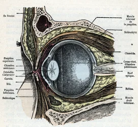 Verticale doorsnede van een oogbal met cataract Gravure uit 