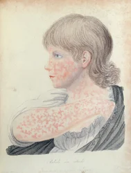 Duitse mazelen, illustratie voor een boek door Robert Willan (1757-1812), 1808 (kleurgravure)