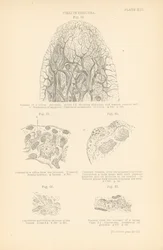 Darmvlokken bij cholera (kleurenlitho)