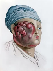 Kankerachtige scrofula, uit Description des Maladies de la Peau door Baron Jean Louis Alibert (1768-1837) Parijs, 1806