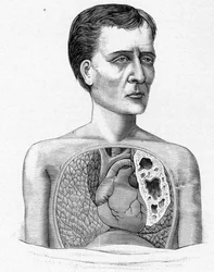Voorstelling van een persoon met grotten, complicatie van tuberculose (gravure)