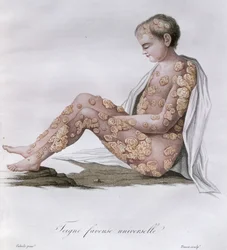 Ringworm, uit een boek door Baron Jean Louis Alibert, 1838