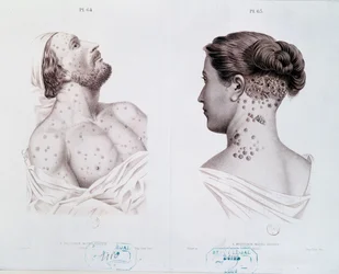 Symptomen van syfilis bij mannen en vrouwen, uit een medisch boek, ca. 1850-60