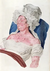 Vrouw met roodvonk, uit een boek van Baron Jean Louis Alibert (1768-1837) gegraveerd door Choupard, 1833