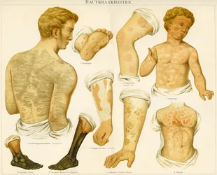 Huidziekten, ca. 1890
