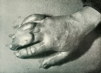 Dr. Atkinsons Bevroren Hand, 5 juli 1911, 1913