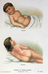 Mazelen en roodvonk, uit een familie medisch boek, c.1900