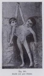 Giacomo en Giovanni Battista Tocci, Italiaanse Siamese tweeling