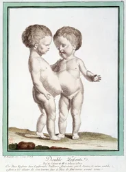 Siamese kinderen - in "Les déviations de la nature" door Régnault