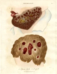 Pathologische illustratie van Sycosis barbae en Sycosis capilli