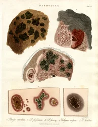 Pathologische huidveranderingen: Porriga en Ecthyma
