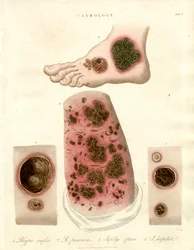Pathologische huidaandoeningen - Pityria; Impetigo en syfilis