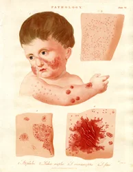 Pathologische huidziekten