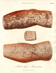 Huiduitslag - Roseola simplex en Roseola paristhmitica