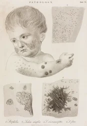 Dermatologie Soorten huidziekten