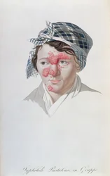 Syfilitische clusterpuisten, uit een boek van Baron Jean Louis Alibert, 1838