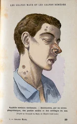 Symptomen van de tertiaire fase van syfilis, 19e eeuw