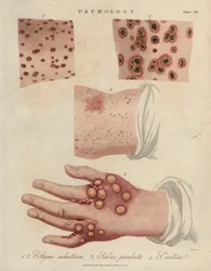 Huidzweer, etterige schurft en schurft veroorzaakt door een scabiei sarcoptische mijt - Lithografie door John Pass, gepubliceerd in Encyclopedia Londinensis door John Wilkes, J.Adlard editie, Londen