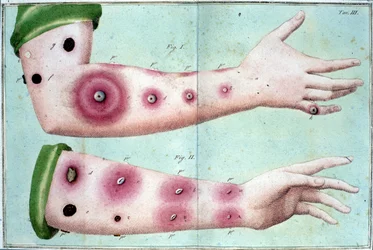 Symptomen van pokken, die een uitbraak van puisten op de huid veroorzaken. Medische plaat uit de "Verhandeling over vaccinatie" van Luigi Sacco, Milaan