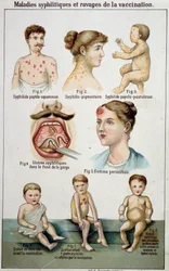 Plaat met de verschillende vormen van syfilitische aandoeningen en de gevaren van vaccinatie - in de natuurgeneeskunde van Bilz, eind 19e eeuw.