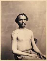 Soldaat Adolph Zirsse, Geslaagde intermediaire excisie van de kop en twee en een halve centimeter van de schacht van de rechter Humerus, uit de fotocatalogus van de chirurgische afdeling